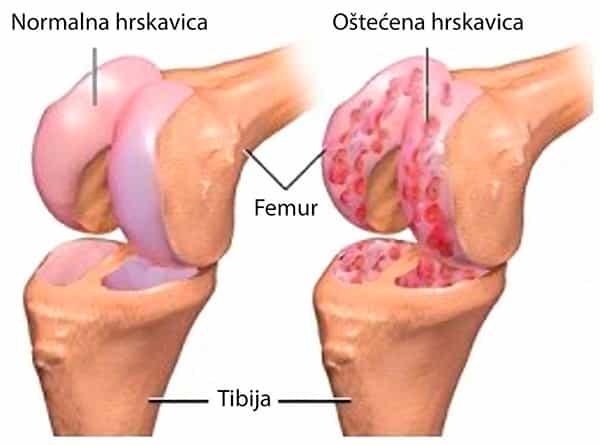 Artrosis articular - blog farmacia 24h - Farmacia 24 horas Palma | Farmacia Balanguera